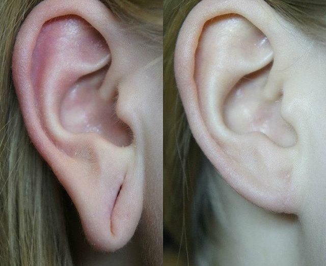 Reconstrucción del lóbulo rasgado tras dilataciones. fotos antes y despues de la cirugía reparadora.