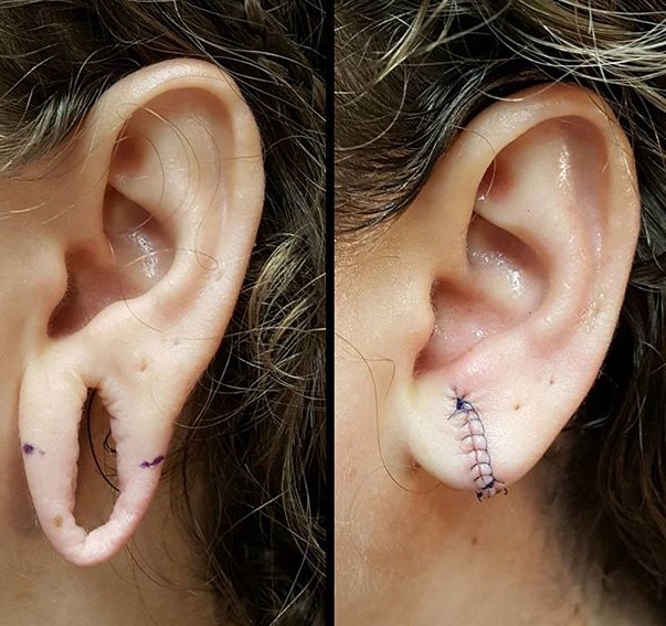 Reconstrucción del lóbulo rasgado tras dilataciones. fotos antes y despues de la cirugía reparadora.