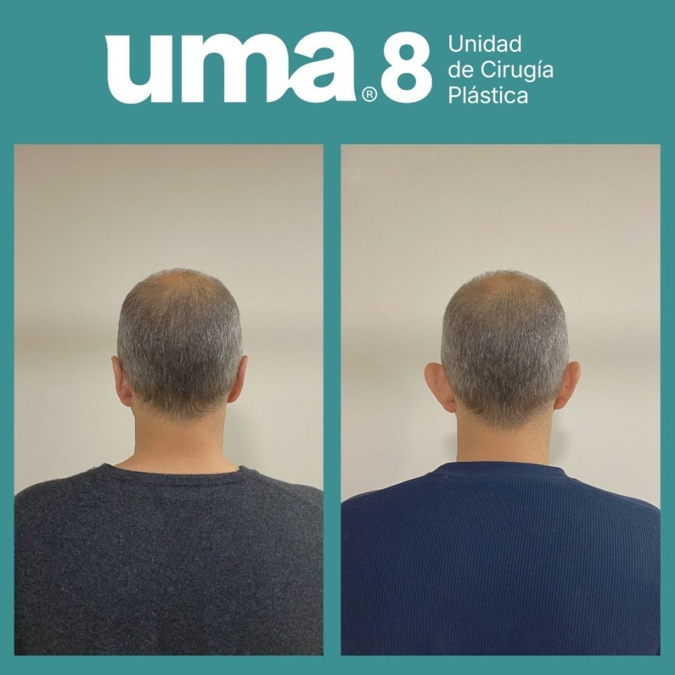 Fotos antes y despues de una otoplastia del Dr.Larrañaga, en UMA8 cirugia plastica Vigo