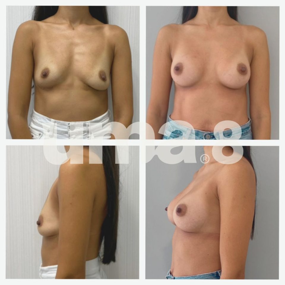 ¿Mastopexia o aumento de pecho? Dr. Larrañaga UMA8 Cirugía Plástica