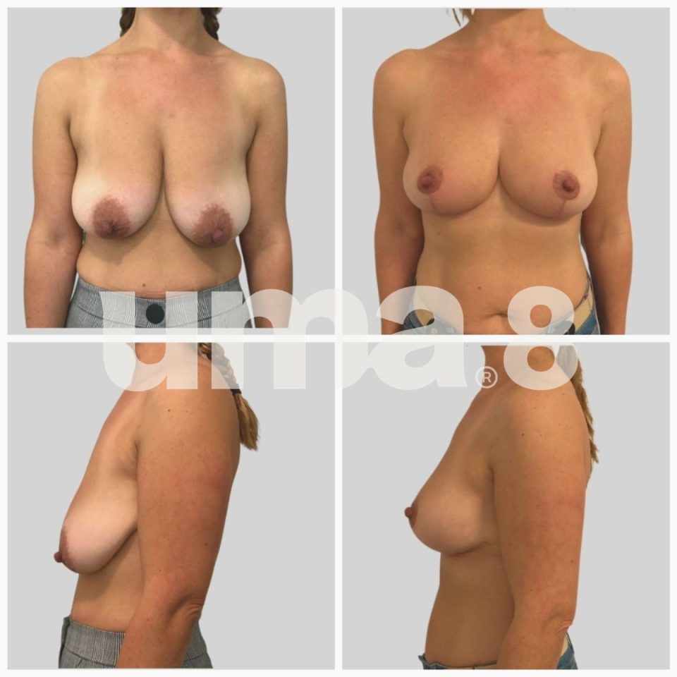 ¿Mastopexia o aumento de pecho? Antes y después Dr.Larrañaga, UMA8 Cirugía Plástica