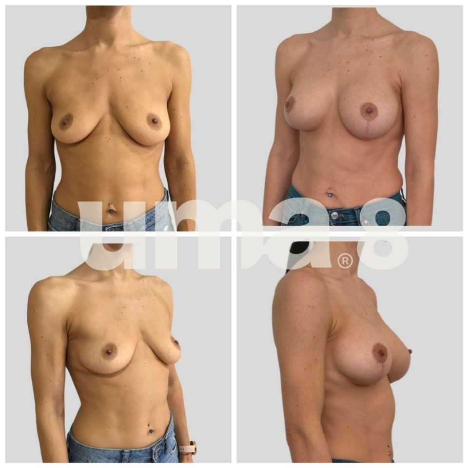 ¿Mastopexia o aumento de pecho? Fotos antes y despues, Dr.Larrañaga UMA8 Cirugía Plástica