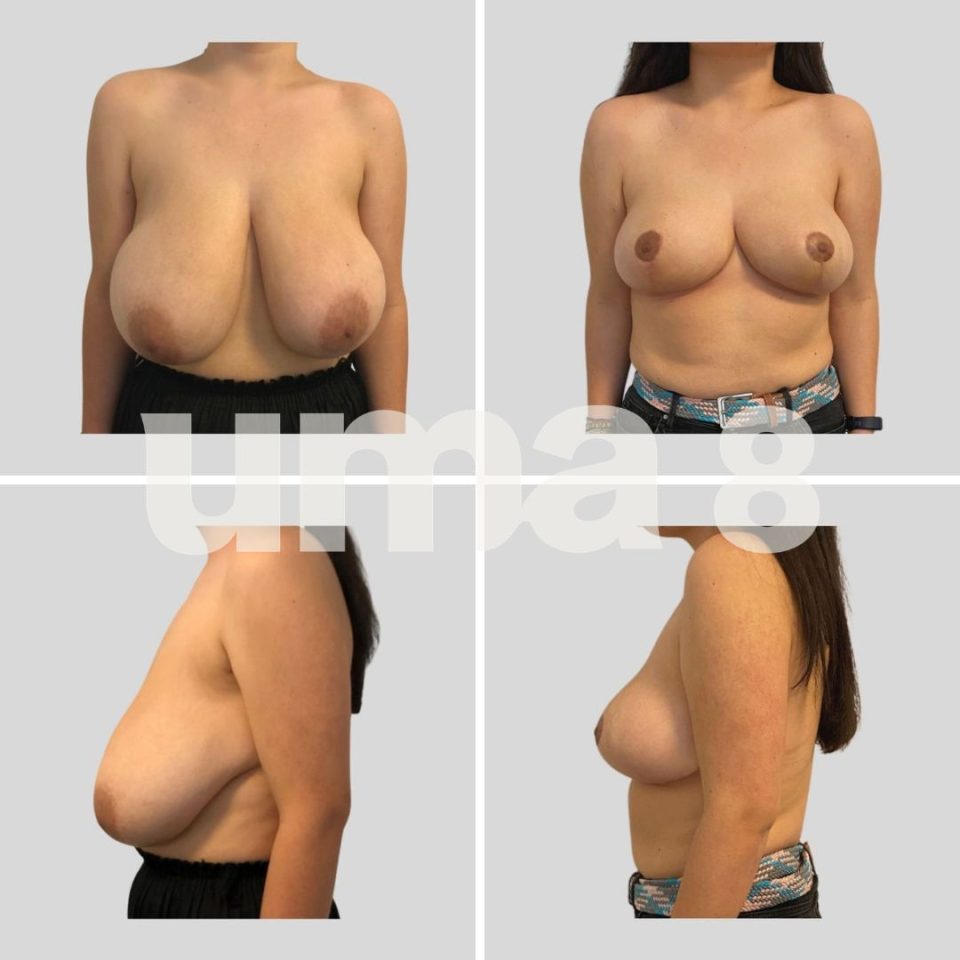 ¿En qué consiste la reducción mamaria?