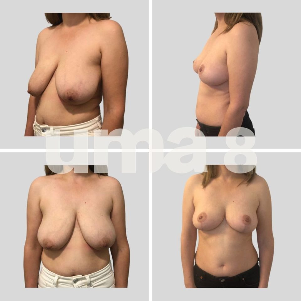 ¿En qué consiste la reducción mamaria? 