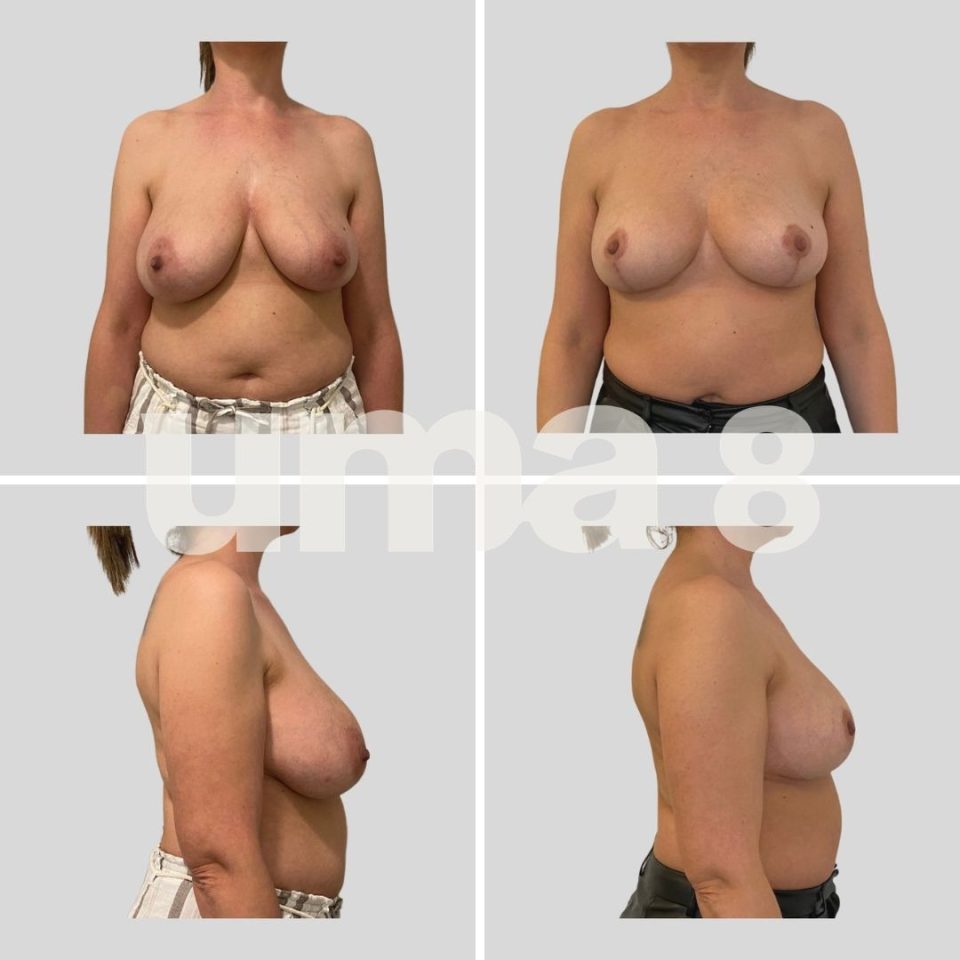 ¿En qué consiste la reducción mamaria? 